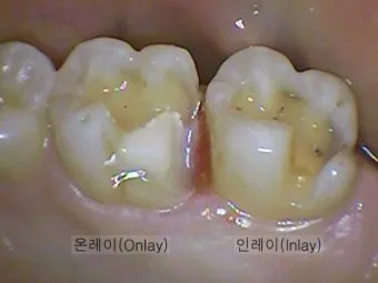 인레이 온레이의 차이와 치료 방법_9