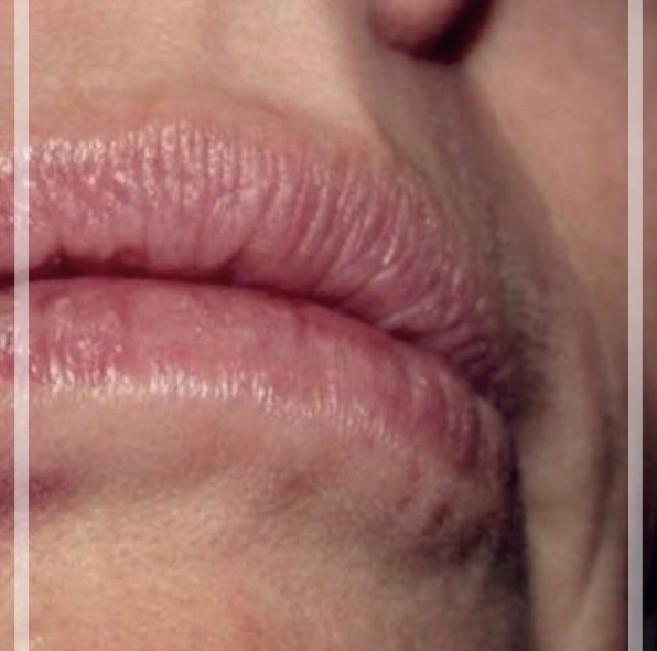 박탈성 구순염 완치 방법 3가지