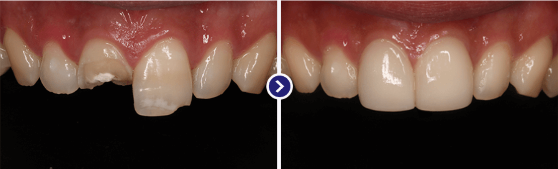 미니쉬 시술 과정