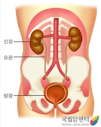 방광암 초기 치료