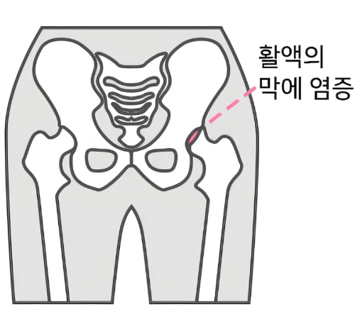 고관절 활액낭염