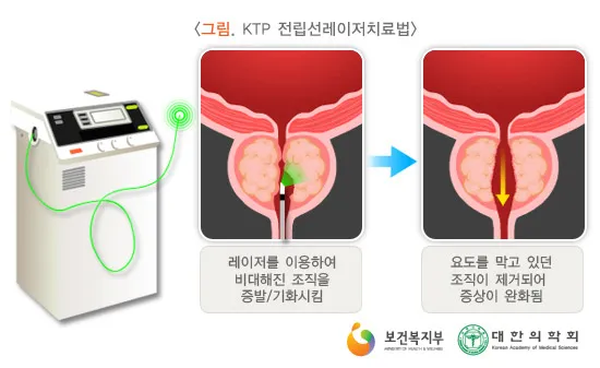 전립선비대증 치료