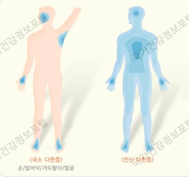 다한증의 부위에 대한 설명