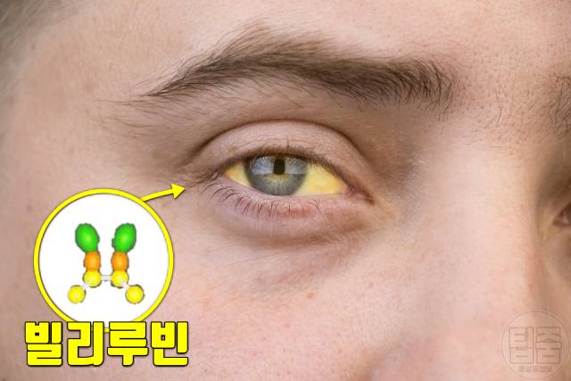 간암 증상 생로병사의비밀 황달 눈