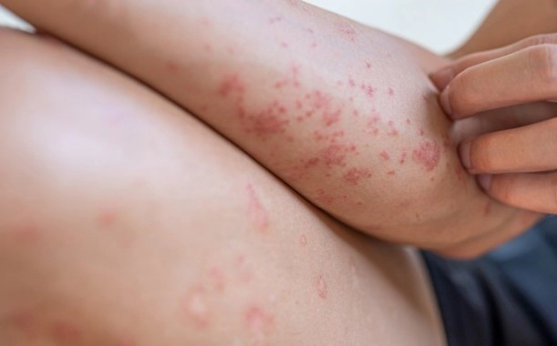 아토피 가려움증 해소방법 11가지