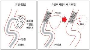 코일색전술
