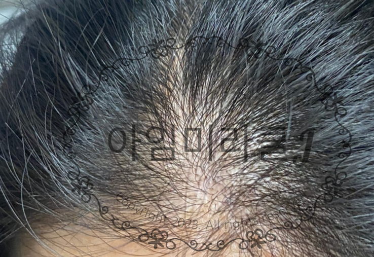 탈모가 진행 중인 모습