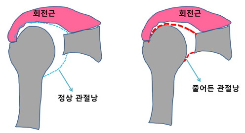 어깨를 감싸고 있는 관절낭이 굳은 그림