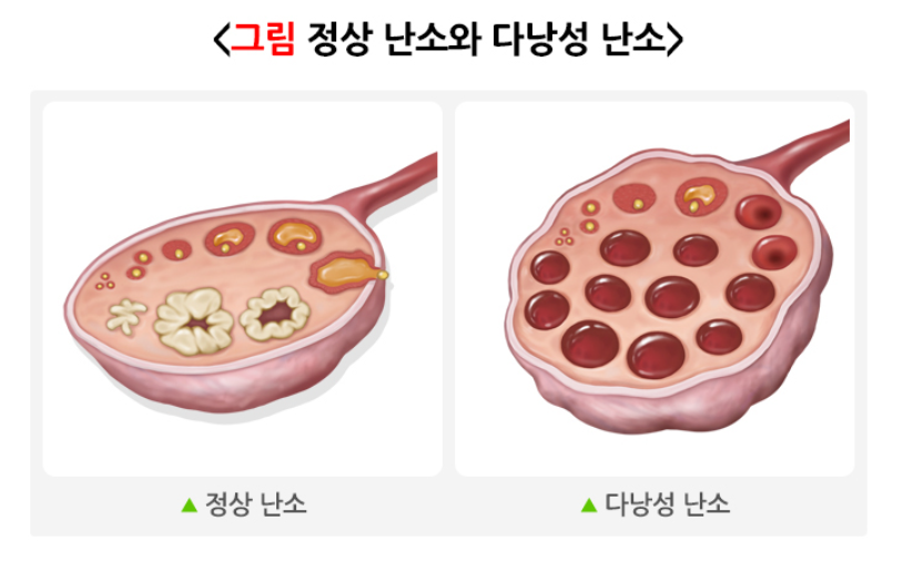 정상난소와 다낭성 난소