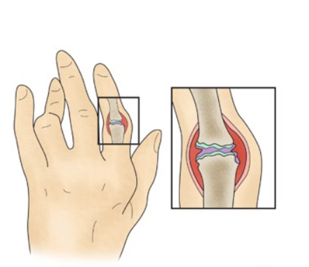 류마티스 관절염 손가락