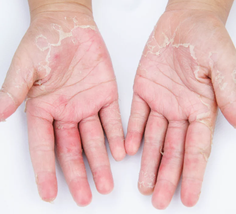 손바닥 껍질이 벗겨지는 이유