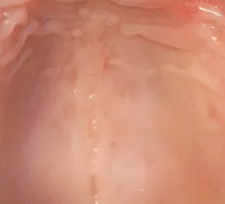 백반증 초기증상 25