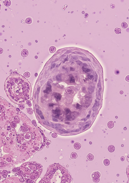 신장 결석이란?