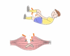 근육통에 고통받는 사람과 찢어진 근육