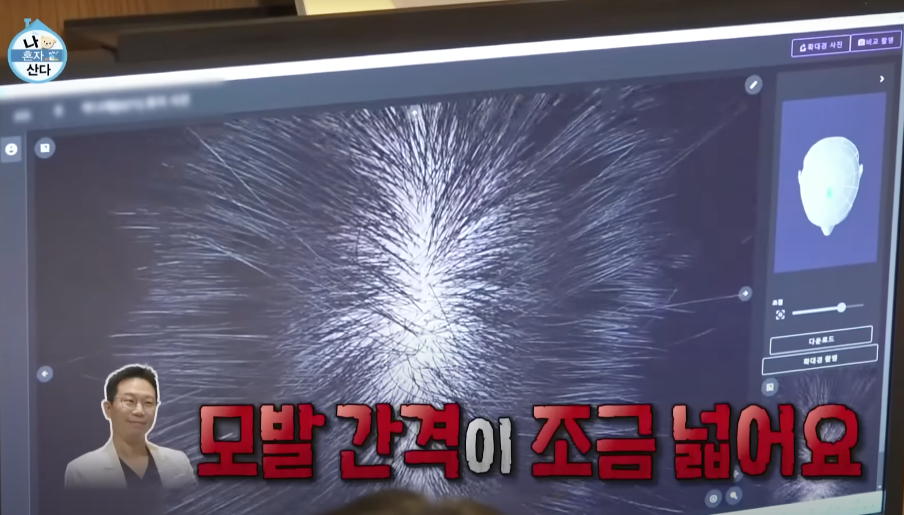 박나래탈모 나혼자산다 MBC