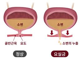 여성 방광염 증상
