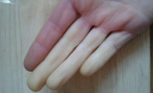 새끼 손가락 저림