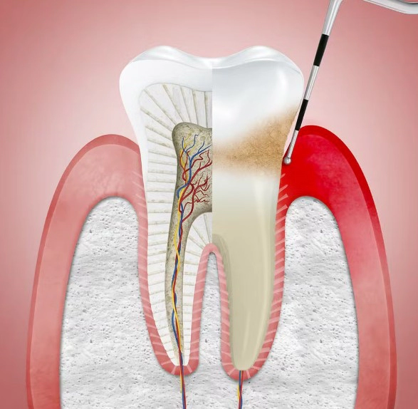 치은염 증상 8가지
