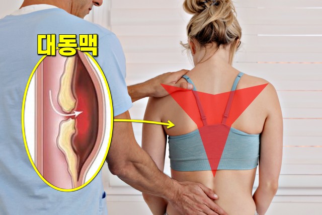 등 위쪽 통증 5, 등이 아픈 증세, 대동맥 박리증 증상,생로병사의 비밀