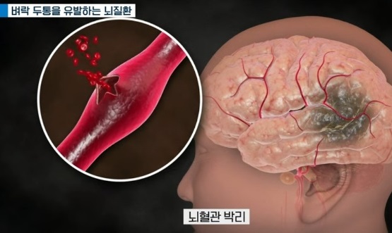 벼락두통-뇌질환