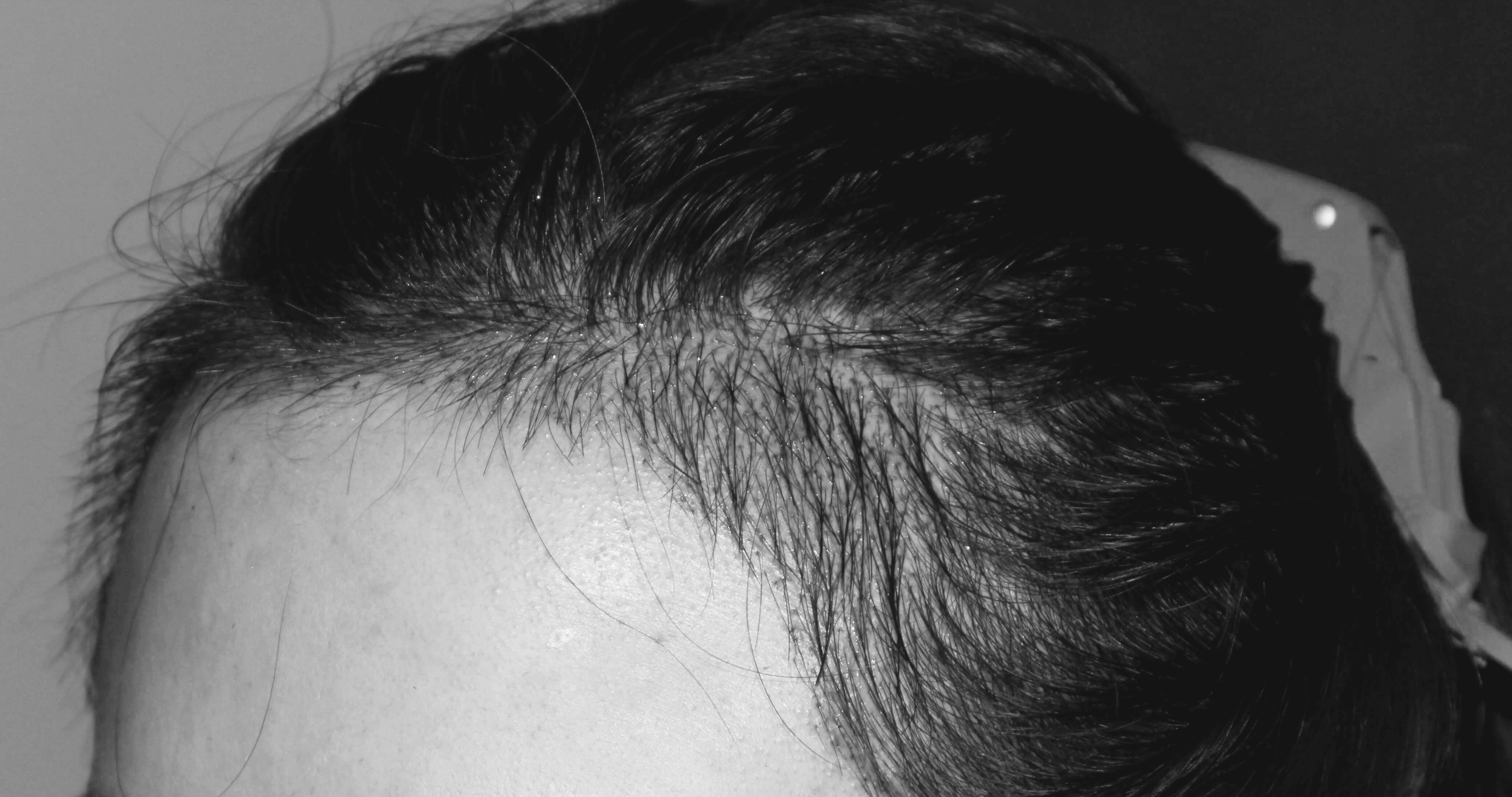 여자 헤어라인 수술 당일 직후