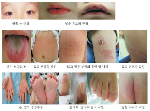 가와사키병-증상