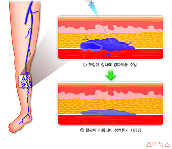 하지정맥류 경화 치료법_출처:국가건강정보포털