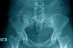 좌골신경통-증상