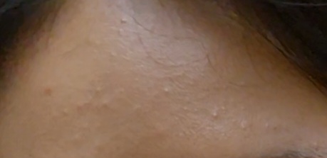 사용 전 이마