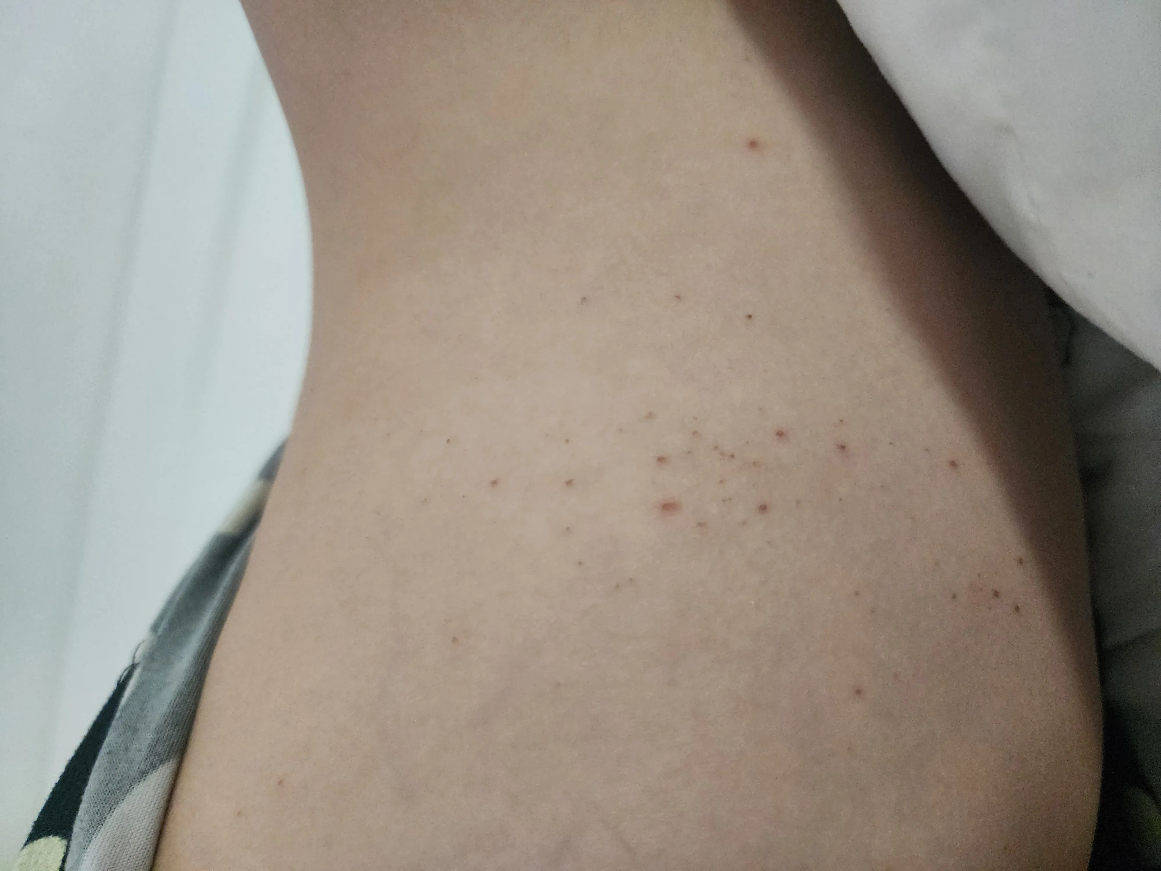 통증 및 발열