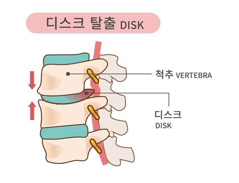 허리가 아픈 이유