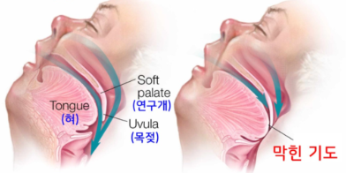 수면 무호흡의 원인