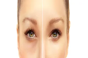 눈밑지방재배치-수술비용