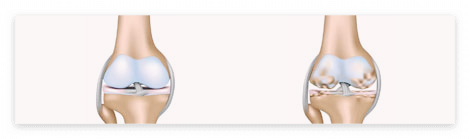 콘드로이친 효능