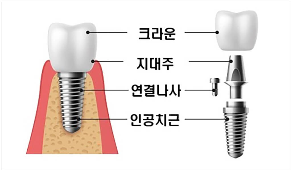 임플란트 가격