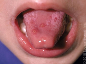 아기 수족구 초기증상&middot;전염성&middot;음식 관리 전문가 가이드