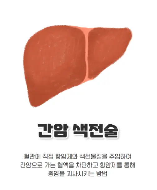 간암 색전술