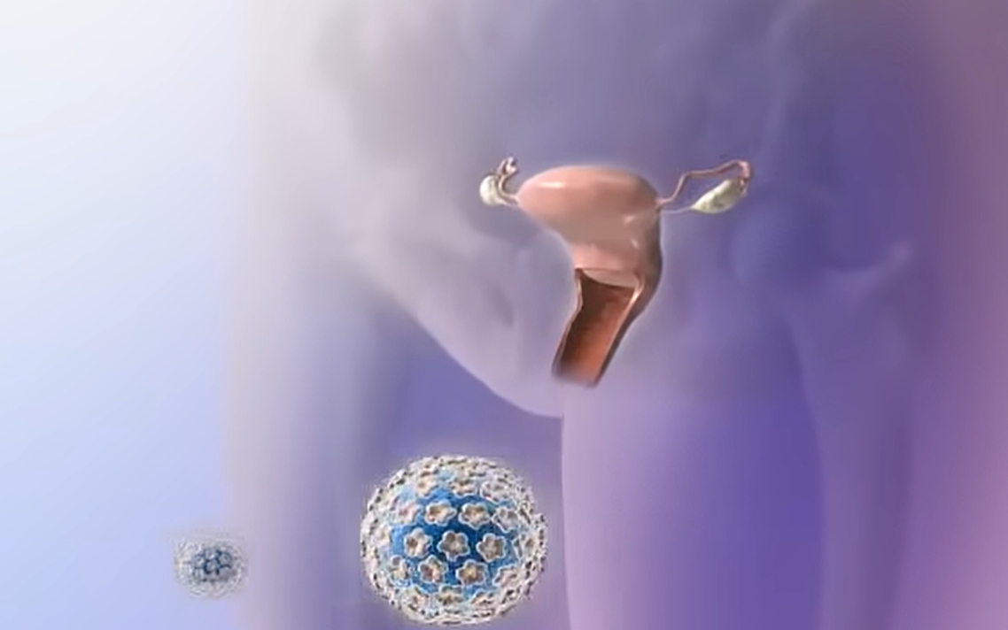 hpv 바이러스 원인