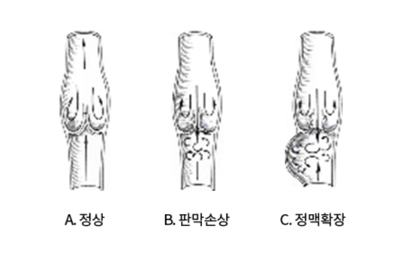 하지정맥류 증상과 관리 방법