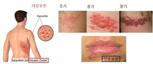 대상포진 전염 증상 이미지