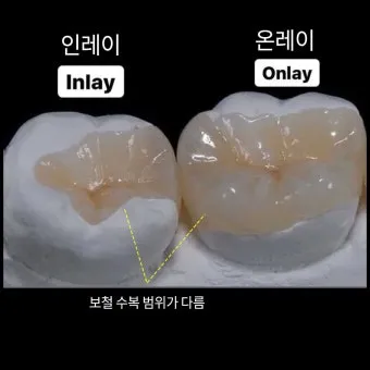 인레이 온레이의 차이와 치료 방법_52
