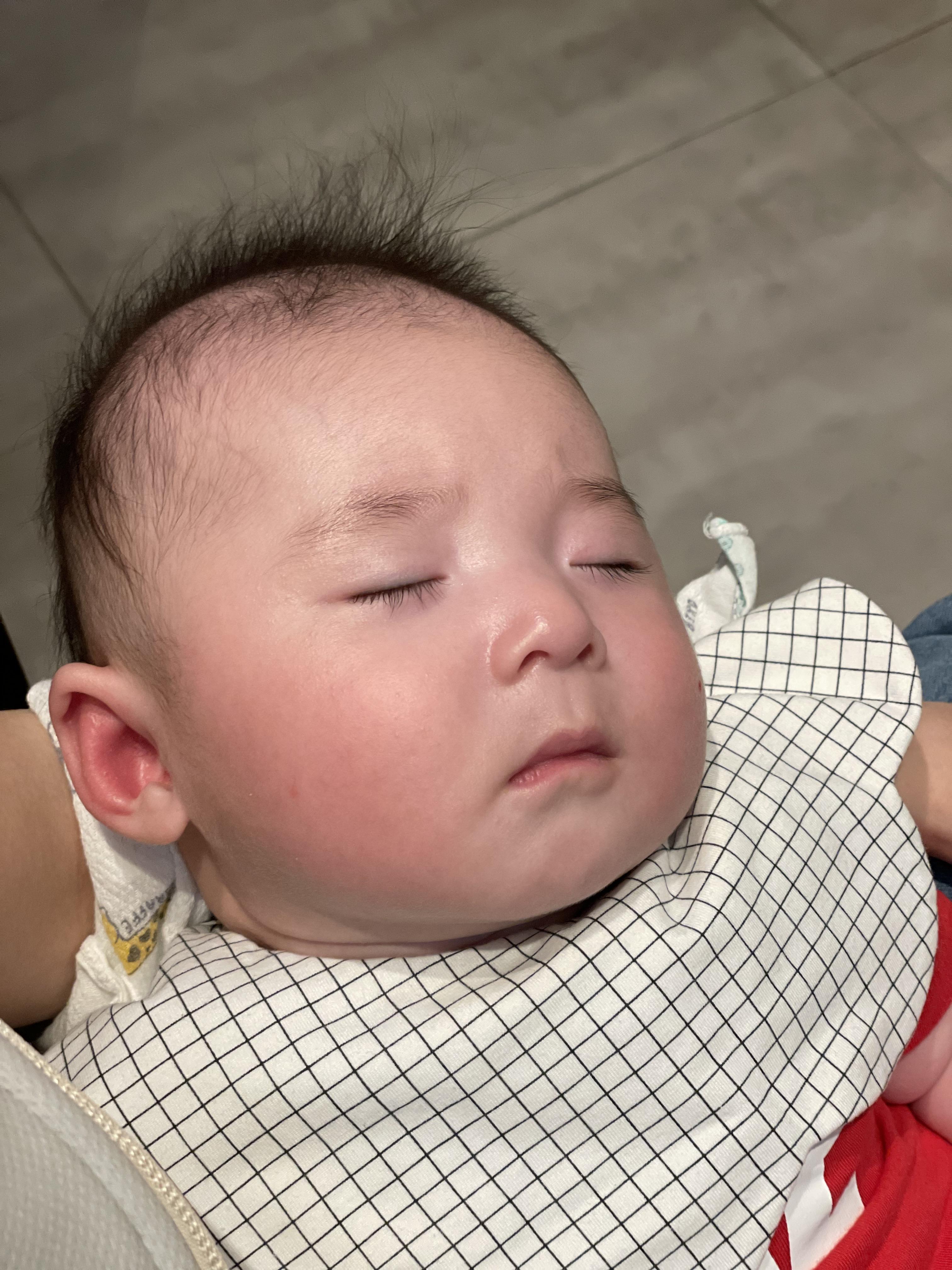 혈관종 에스앤유 피부과