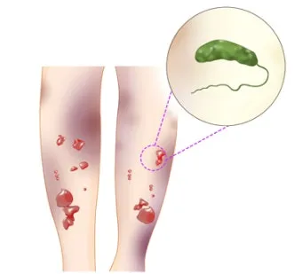 패혈증이란 무엇인지 원인 증상 치료 예방법_3
