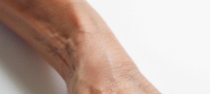 류마티스관절염