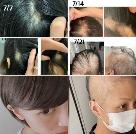 일본-모더나-탈모-부작용