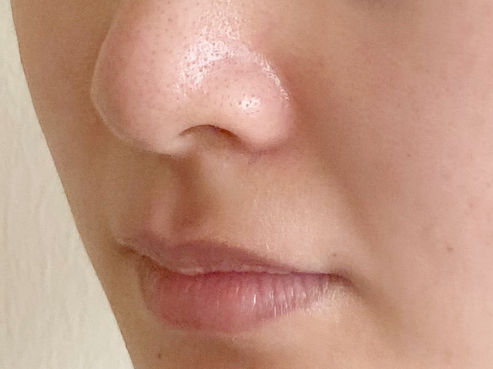 팔자 보톡스 후기