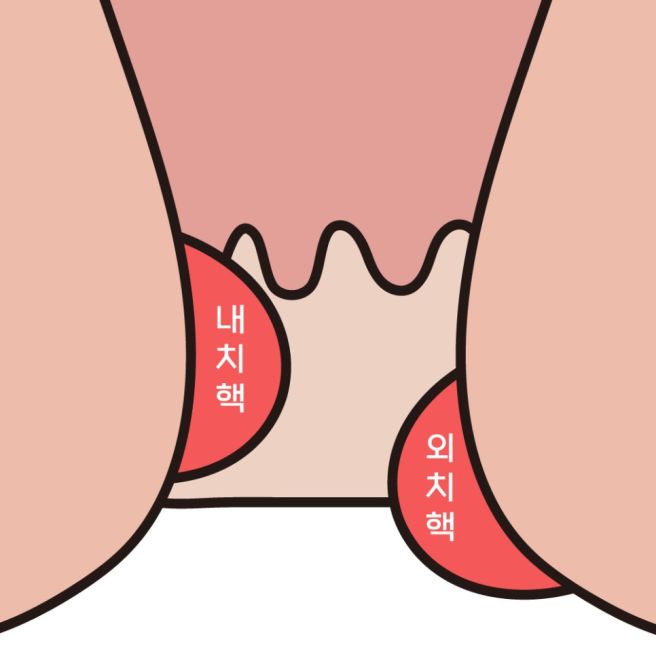 혈변의 원인