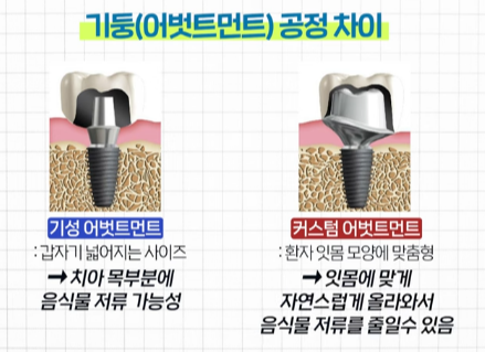 기성 어벗트먼트와 커스텀 어벗트먼트 공정 차이