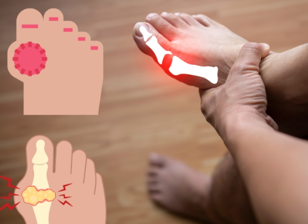 통풍발작 응급 대처 치료 방법 - 소염진통제 복용