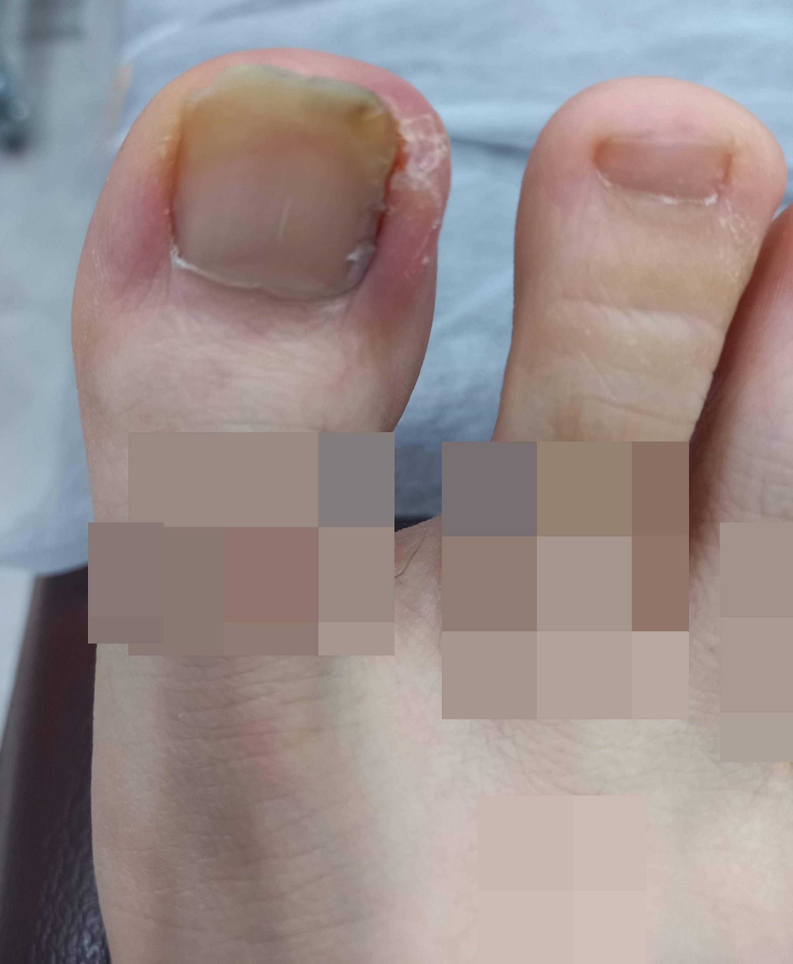 내향성발톱-시술